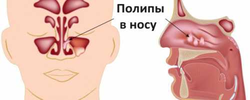 Если полип образуется в детском возрасте, то об этом доктору сообщит уже сам внешний вид ребенка