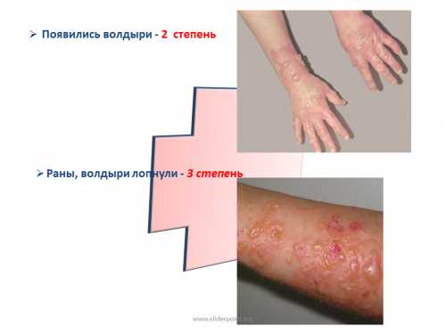Наиболее эффективными считаются средства и лекарства, содержащие левомицетин, витамин