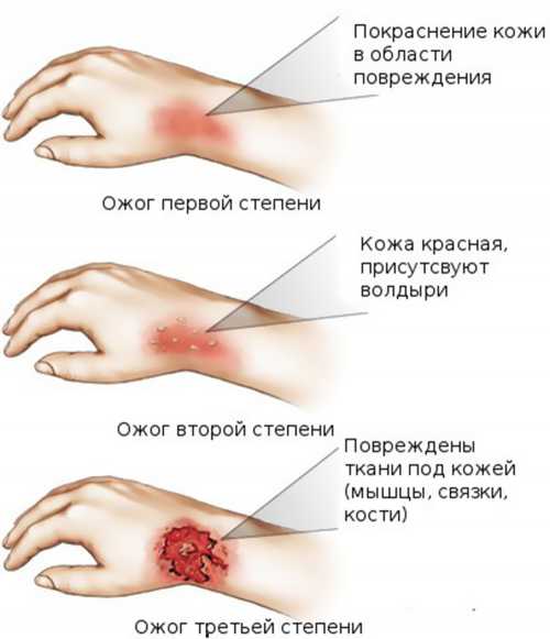 Ожоги: лечение в домашних условиях, что поможет и