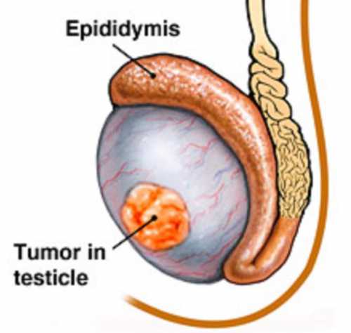 Рак яичка у мужчины: симптомы, причины, это
