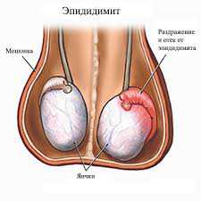 Обычно причиной обращения к врачу является появление на мошонке плотного узелка или небольшой безболезненной припухлости в сочетании с ноющей или тупой болью внизу живота