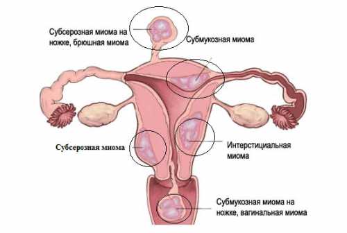 Чтобы приготовить лекарство от миомы матки, следует сорвать несколько самых крупных цветочных головок, измельчить их руками и залить мл кипятка