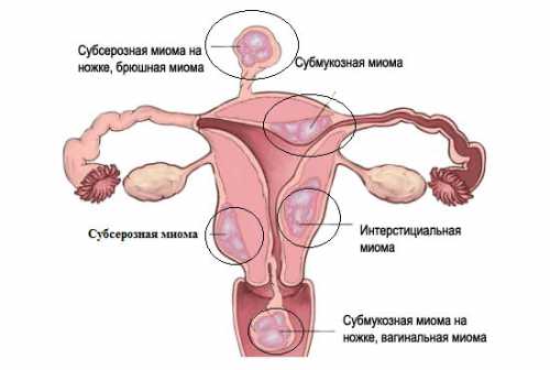 Чтобы приготовить лекарство от миомы матки, следует сорвать несколько самых крупных цветочных головок, измельчить их руками и залить мл кипятка