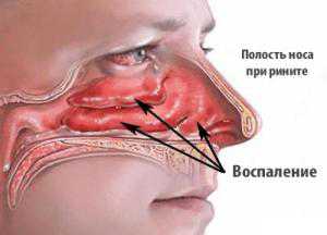 Воспаление слизистой носа: симптомы, причины, это