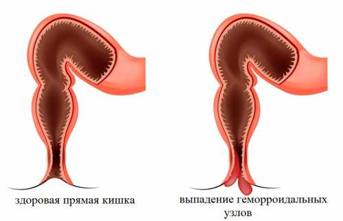 Боль в области ануса при дефекации, сидении, ходьбе