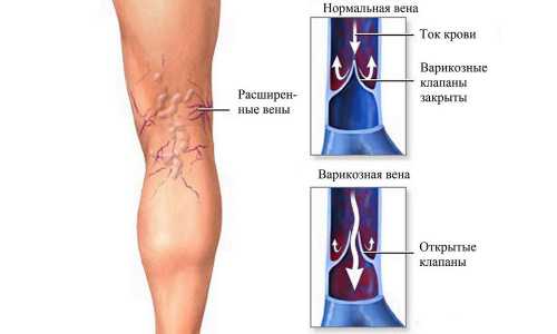 Микрофлебэктомия минифлебэктомия