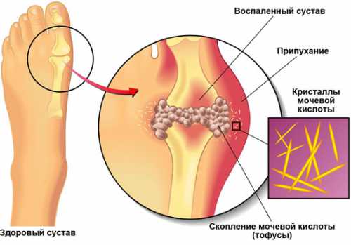 Народные средства от подагры на начальной стадии,