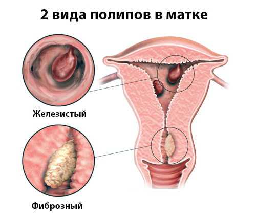 Причины железистого полипа: диагноз, прогноз,