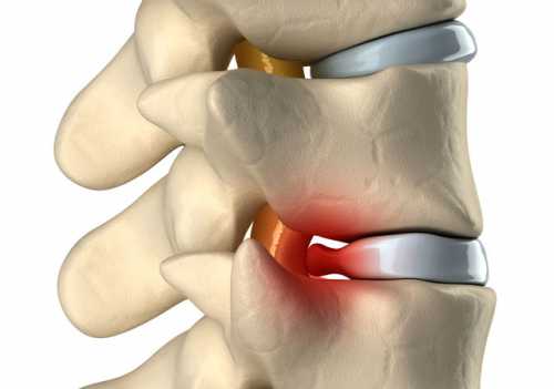 Итак, начнём с того, как появляется грыжа в позвоночнике
