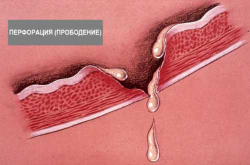 В обязательном порядке назначаются антибиотики широкого спектра действия