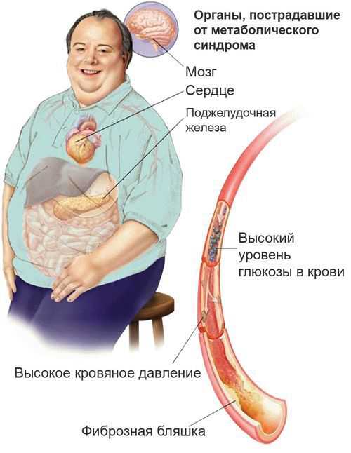 Метаболический синдром